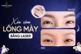 Xóa xăm chân mày: Cách khắc phục mày lỗi nhanh nhất