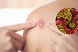 Tụ cầu vàng gây bệnh gì? Nguyên nhân dẫn đến nhiễm khuẩn tụ cầu vàng