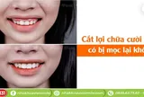 Cắt lợi chữa cười hở lợi có bị mọc lại không?
