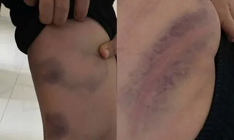 Bé trai ở Bắc Ninh bị cha đánh bầm tím vì lười học