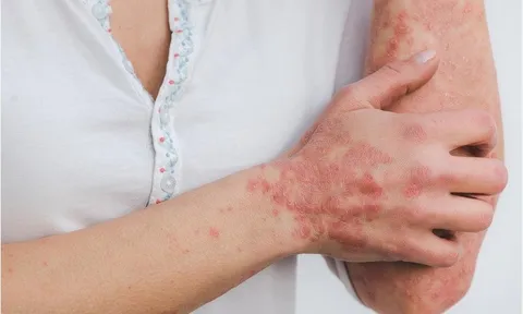 Có nên tự dùng thuốc để điều trị bệnh vảy nến