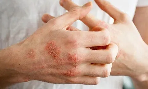 Chữa bệnh chàm nhanh nhất ở Bảo Thanh Đường