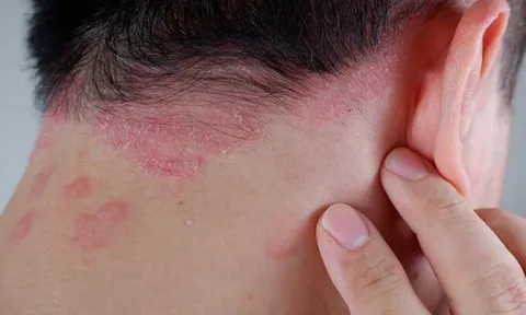 Điều trị sớm bệnh vẩy nến tránh nguy cơ biến chứng