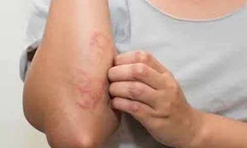 Khỏi Viêm Da Cơ Địa Đeo Bám Hơn Chục Năm Bằng Phương Thuốc Từ Thảo Dược