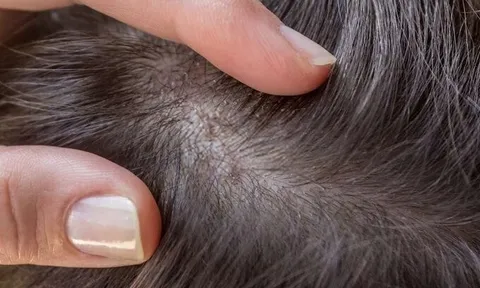 Bảo Thanh Đường - Điều trị dứt điểm bệnh viêm chân tóc