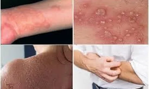 Bảo Thanh Đường - Địa chỉ uy tín chữa tận gốc bệnh chàm (eczema)