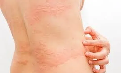 Nổi mề đay sau sinh: Nguyên nhân, Triệu chứng và Giải pháp điều trị