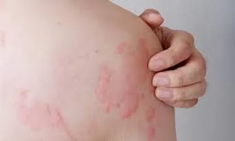 Nổi mề đay sau sinh: Nguyên nhân, Triệu chứng và Giải pháp điều trị
