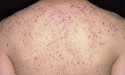 Viêm Nang Lông: Nguyên Nhân, Triệu Chứng & Cách Điều Trị Hiệu Quả