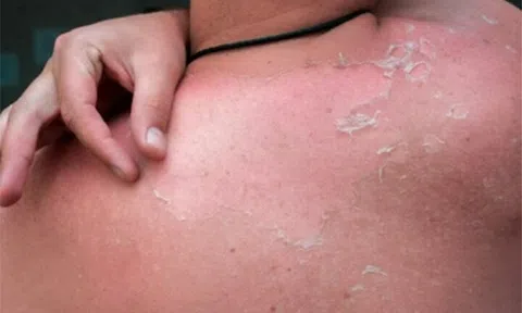 Tác hại của cháy nắng đến da như thế nào?
