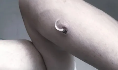 Giun rồng 'đục khoét' cơ thể người đàn ông