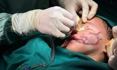 Bé 2 tuổi bị chó nhà nuôi cắn xé khắp mặt
