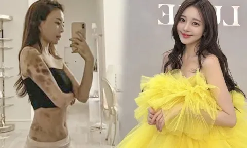 Hot girl Hàn bàng hoàng khi cả cơ thể bầm tím sau 2 giờ gây mê làm đẹp