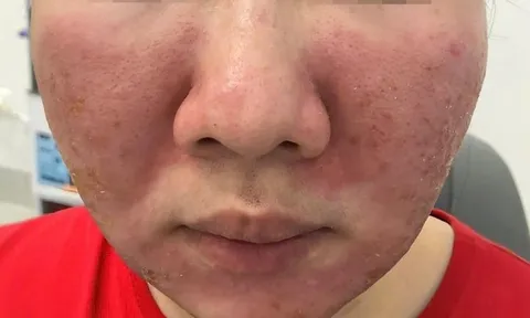 Mặt bỏng, da sạm vì tin kem 'siêu chống nắng' giá 95.000 đồng trên mạng