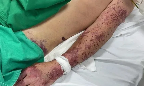 Sau vài ngày sốt cao, người đàn ông ở Hà Nội không qua khỏi