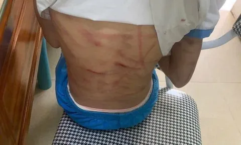 Xác minh thông tin bé gái nghi bị cha dượng bạo hành
