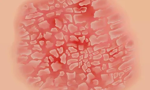 Vảy nến tái phát - Cách điều trị từ lời khuyên các chuyên gia Bảo Thanh Đường