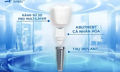 Trụ Implant có phải bộ phận quan trọng nhất? Lý giải 4 lầm tưởng thường gặp