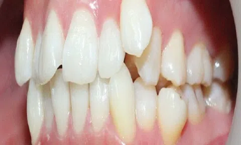 Phương pháp điều trị răng mọc không đều hiệu quả nhất hiện nay