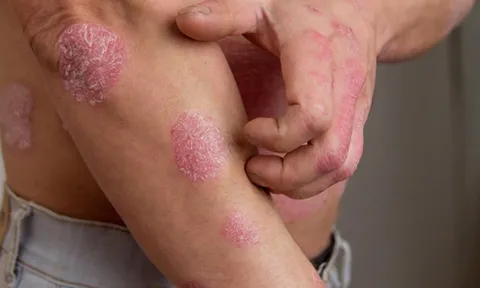 Bổ huyết - Dưỡng âm: Nguyên tắc trong điều trị bệnh viêm da lâu ngày