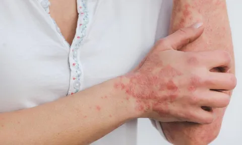 Điều trị sớm bệnh vẩy nến tránh nguy cơ biến chứng