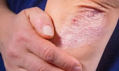 Có nên tự dùng thuốc để chữa bệnh vảy nến?