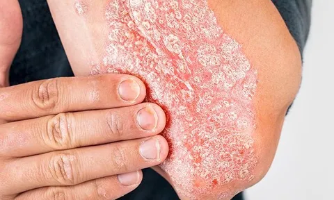 Bệnh vảy nến có lây không?