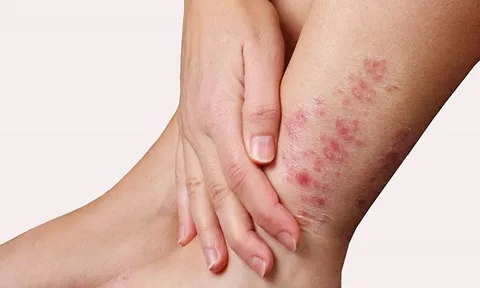 Bảo Thanh Đường - Địa chỉ uy tín chữa tận gốc bệnh chàm (eczema)