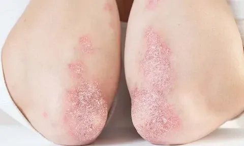 Bệnh Vảy Nến: Các Dạng Thường Gặp Và Bí Quyết Điều Trị Từ Y Học Cổ Truyền