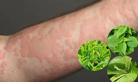 Mẹo dân gian trị ngứa da: Hiệu quả đến đâu?
