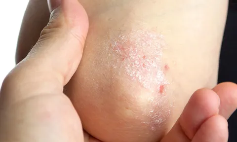 Chữa bệnh vảy nến thể giọt bằng thảo dược