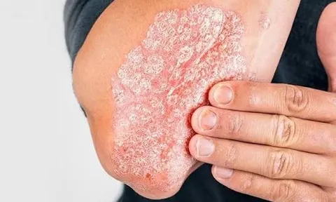 Trang chủ   Bệnh thường gặp CÁCH CHỮA BỆNH VẢY NẾN LÂU NĂM