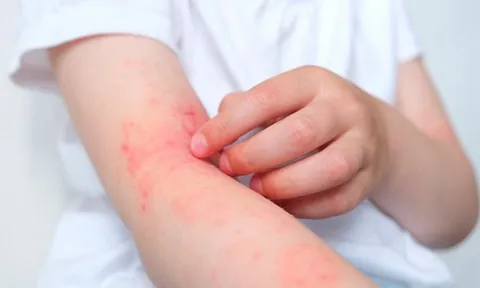 Điều Trị Viêm Da Cơ Địa Bằng Thuốc Nam: Hướng Đi Lành Tính, Hiệu Quả Và Bền Vững