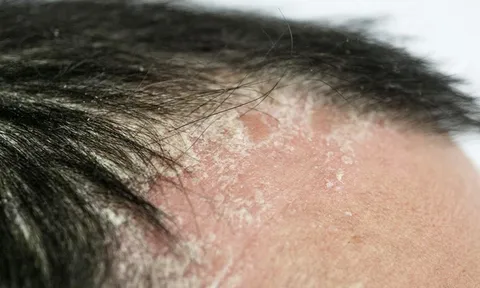 Vảy Nến Có Khó Chữa Không? Góc Nhìn Từ Y Học Cổ Truyền