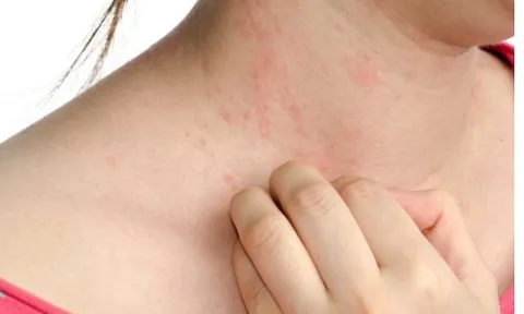 Dị Ứng Thời Tiết Nổi Mẩn Khắp Người Phải Làm Sao?
