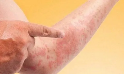 Nguyên nhân khiến bệnh ngoài da dai dẳng và dễ tái phát