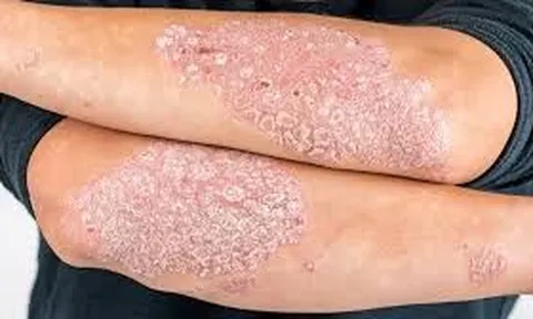 Bệnh Vảy Nến: Phân Tích Toàn Diện Về Mức Độ Nguy Hiểm Và Các Giải Pháp Điều Trị Hiện Đại