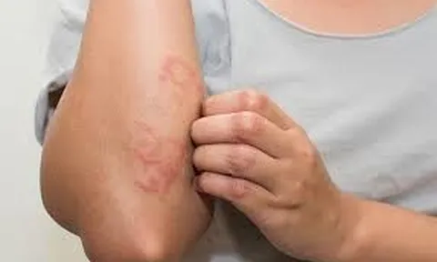 Khỏi Viêm Da Cơ Địa Đeo Bám Hơn Chục Năm Bằng Phương Thuốc Từ Thảo Dược