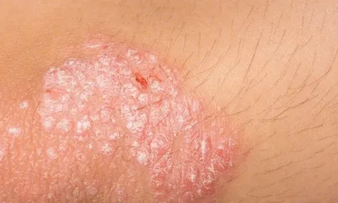 Hành Trình Điều Trị Vảy Nến Tại Phòng Khám Bảo Thanh Đường: Từ Những Ngày Tháng Đau Đớn Đến Sự Hồi Sinh