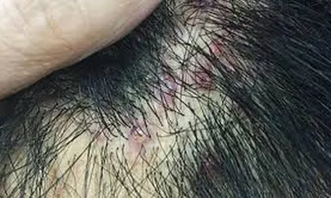 Bảo Thanh Đường - Điều trị dứt điểm bệnh viêm chân tóc