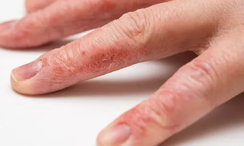 Chữa bệnh chàm á sừng bằng phương thuốc quý tại Bảo Thanh Đường