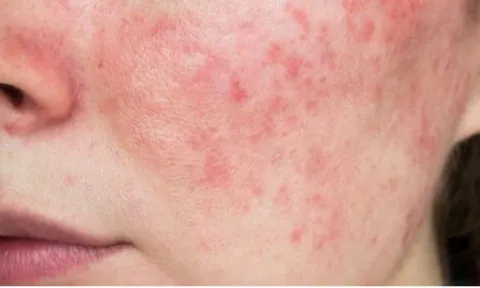 Cách nhận biết da bị nhiễm corticoid và hướng xử lý bằng thảo dược