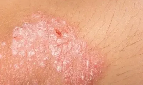 Cần làm gì khi mắc bệnh vảy nến?