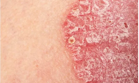Các giai đoạn vảy nến thường gặp và hướng điều trị