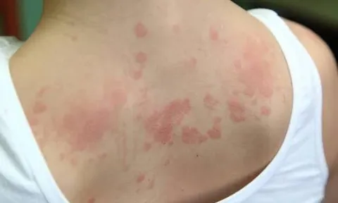 Bổ huyết - Dưỡng âm: Nguyên tắc trong điều trị bệnh viêm da lâu ngày