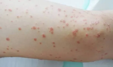 Chữa bệnh vảy nến thể giọt bằng thảo dược