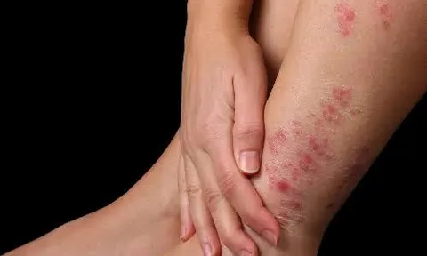 Bệnh vảy nến có lây không?