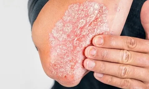 Vảy nến tái phát phải làm sao? Lắng nghe tư vấn từ chuyên gia
