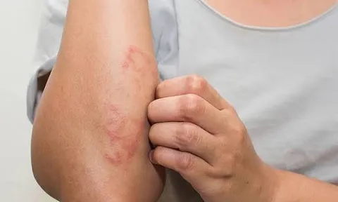 Điều Trị Viêm Da Cơ Địa Bằng Thuốc Nam: Hướng Đi Lành Tính, Hiệu Quả Và Bền Vững