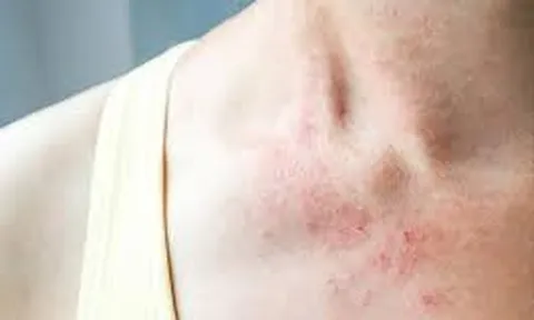 Dị Ứng Thời Tiết Nổi Mẩn Khắp Người Phải Làm Sao?